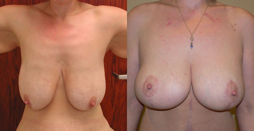 Breast Lift with Augmentation after Weight Loss before and after photo by Columbus Institute of Plastic Surgery in Columbus, OH