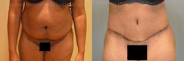 Abdominoplasty (Tummy Tuck) before and after photo by Columbus Institute of Plastic Surgery in Columbus, OH