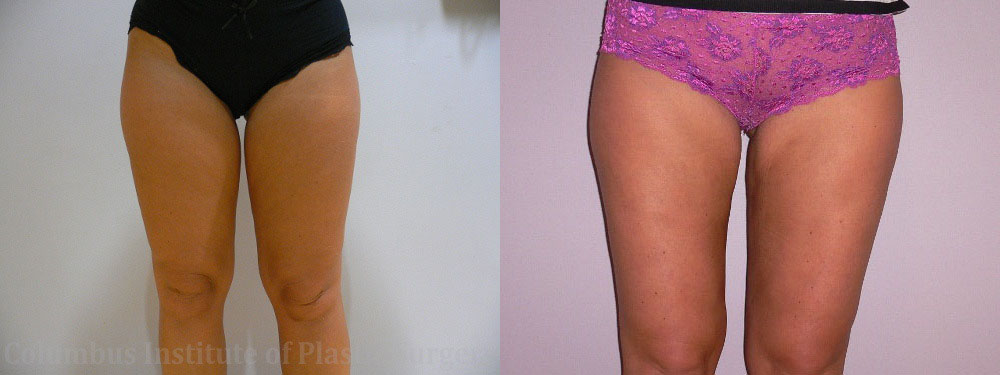 Liposuction before and after photo by Columbus Institute of Plastic Surgery in Columbus, OH