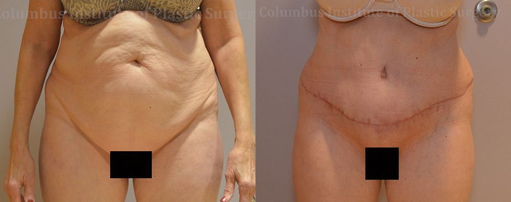 Abdominoplasty (Tummy Tuck) before and after photo by Columbus Institute of Plastic Surgery in Columbus, OH