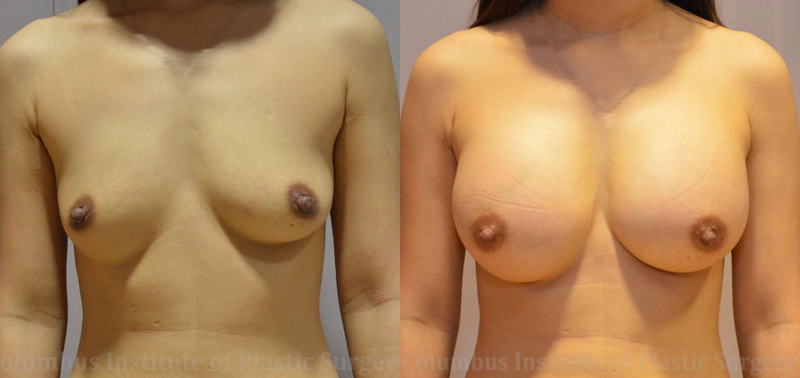 Breast Augmentation – 400cc-500cc before and after photo by Columbus Institute of Plastic Surgery in Columbus, OH