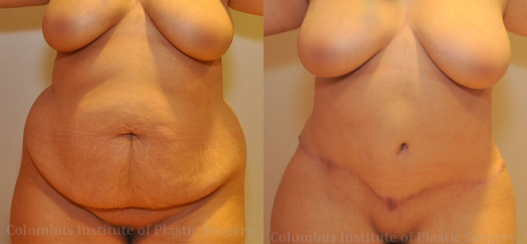 Liposuction before and after photo by Columbus Institute of Plastic Surgery in Columbus, OH