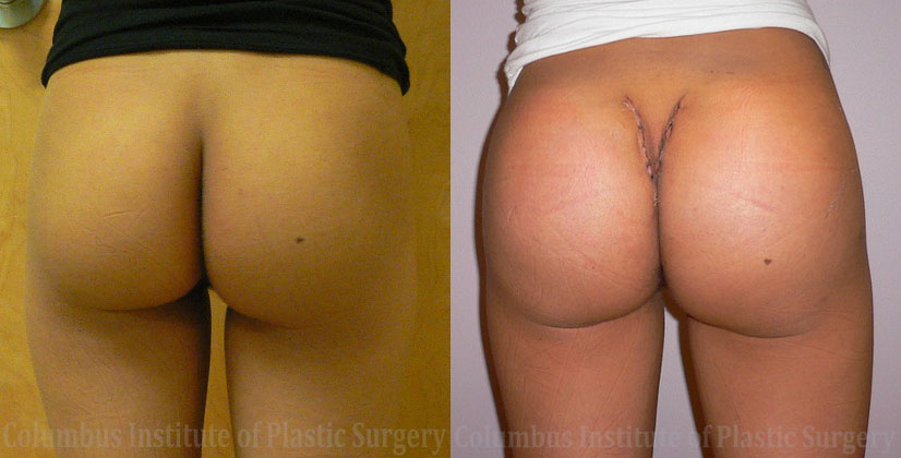 Buttock (Gluteal) Augmentation with Implants before and after photo by Columbus Institute of Plastic Surgery in Columbus, OH