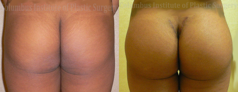 Buttock (Gluteal) Augmentation with Implants before and after photo by Columbus Institute of Plastic Surgery in Columbus, OH