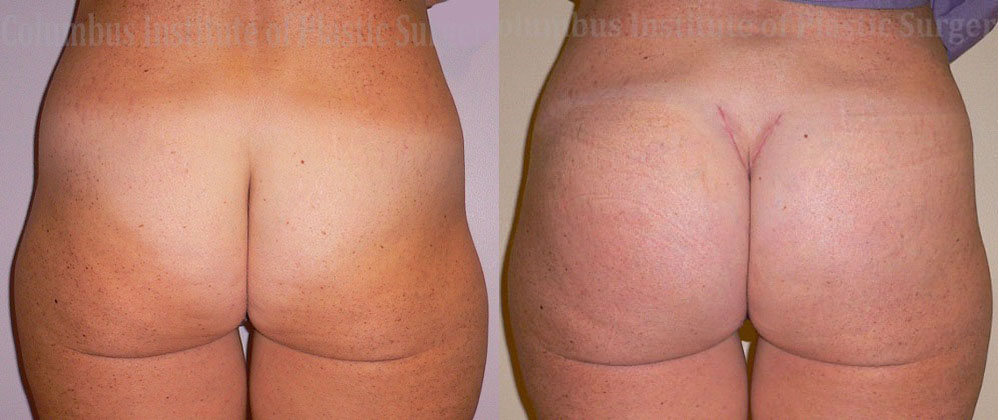Buttock (Gluteal) Augmentation with Implants before and after photo by Columbus Institute of Plastic Surgery in Columbus, OH