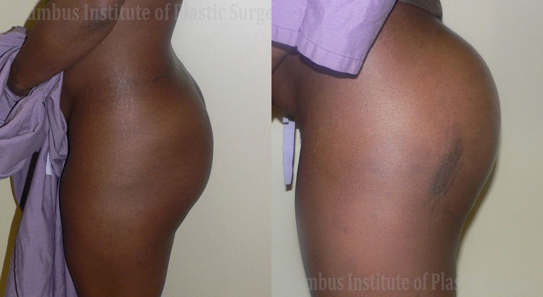 Buttock (Gluteal) Augmentation with Implants before and after photo by Columbus Institute of Plastic Surgery in Columbus, OH