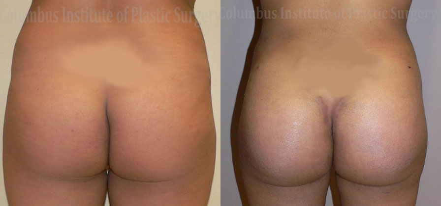 Buttock (Gluteal) Augmentation with Implants before and after photo by Columbus Institute of Plastic Surgery in Columbus, OH