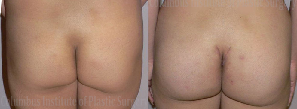 Buttock (Gluteal) Augmentation with Implants before and after photo by Columbus Institute of Plastic Surgery in Columbus, OH