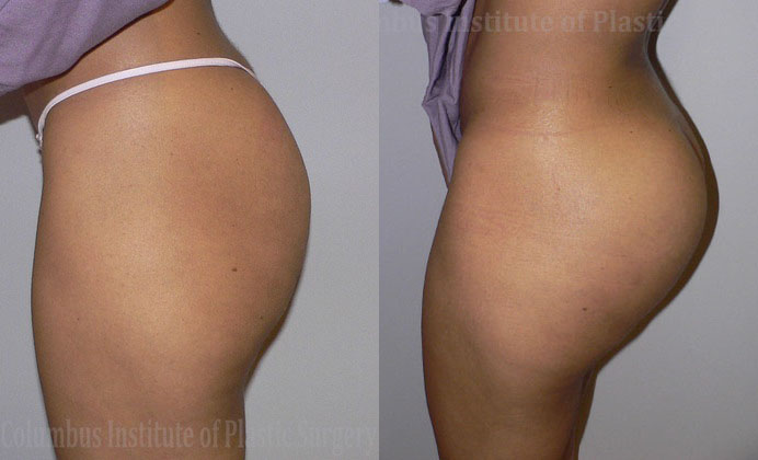 Buttock (Gluteal) Augmentation with Implants before and after photo by Columbus Institute of Plastic Surgery in Columbus, OH