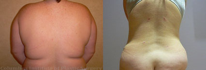 Liposuction before and after photo by Columbus Institute of Plastic Surgery in Columbus, OH