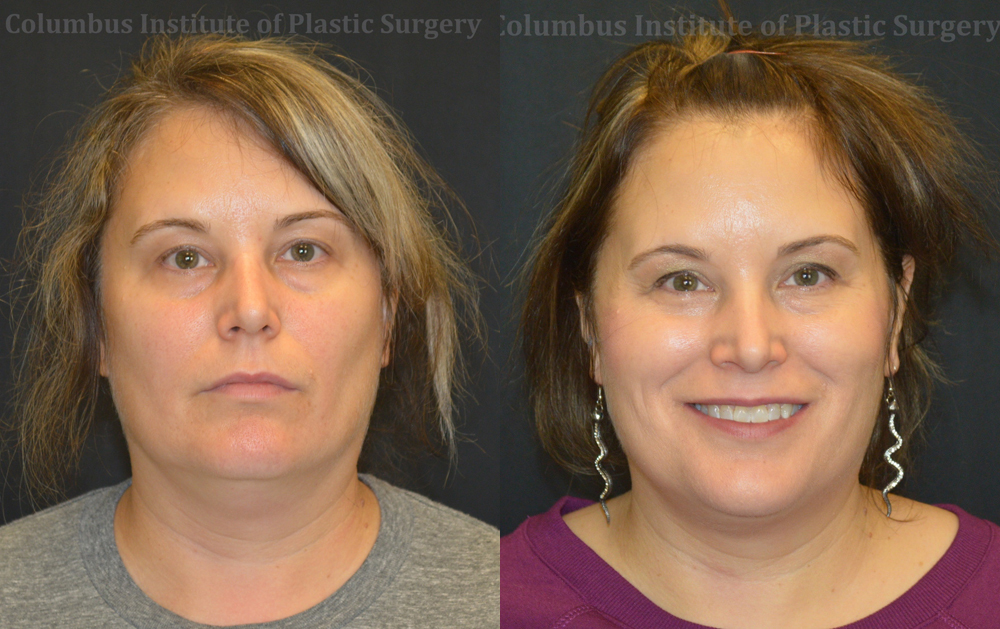 CoolSculpting before and after photo by Columbus Institute of Plastic Surgery in Columbus, OH