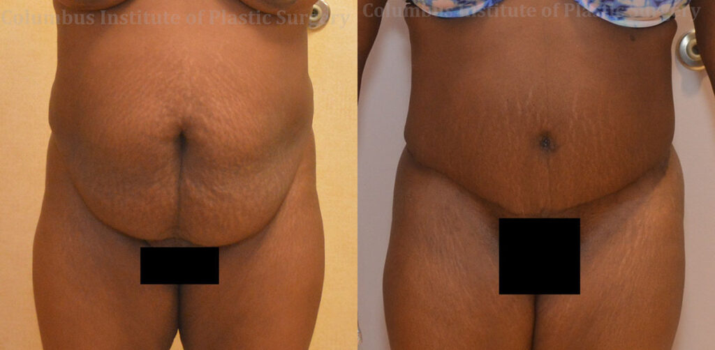 Abdominoplasty (Tummy Tuck) before and after photo by Columbus Institute of Plastic Surgery in Columbus, OH