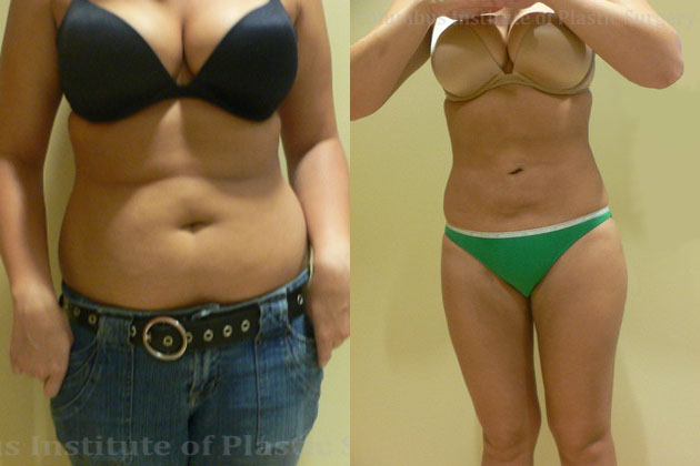 Liposuction before and after photo by Columbus Institute of Plastic Surgery in Columbus, OH