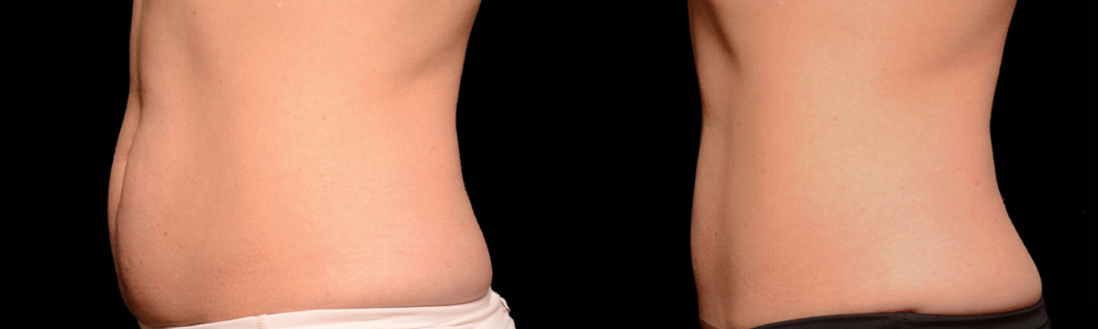 CoolSculpting before and after photo by Columbus Institute of Plastic Surgery in Columbus, OH