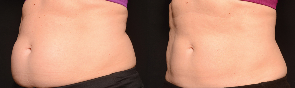 CoolSculpting before and after photo by Columbus Institute of Plastic Surgery in Columbus, OH
