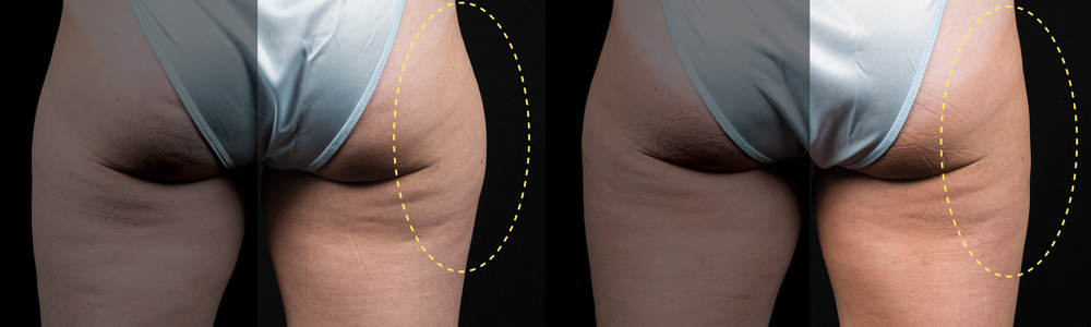 CoolSculpting before and after photo by Columbus Institute of Plastic Surgery in Columbus, OH