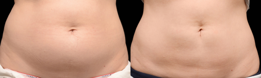 CoolSculpting before and after photo by Columbus Institute of Plastic Surgery in Columbus, OH