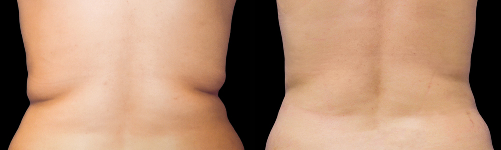 CoolSculpting before and after photo by Columbus Institute of Plastic Surgery in Columbus, OH