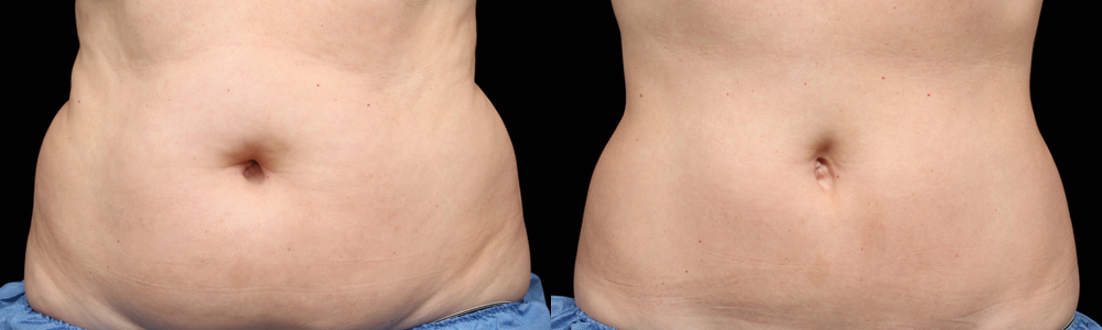 CoolSculpting before and after photo by Columbus Institute of Plastic Surgery in Columbus, OH