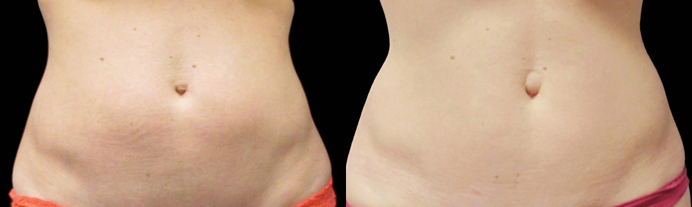 CoolSculpting before and after photo by Columbus Institute of Plastic Surgery in Columbus, OH