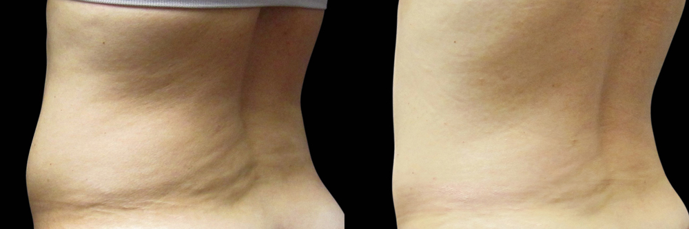 CoolSculpting before and after photo by Columbus Institute of Plastic Surgery in Columbus, OH