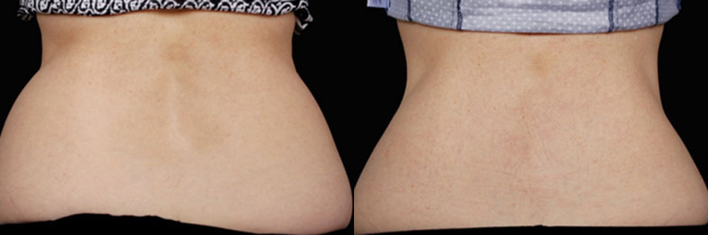 CoolSculpting before and after photo by Columbus Institute of Plastic Surgery in Columbus, OH