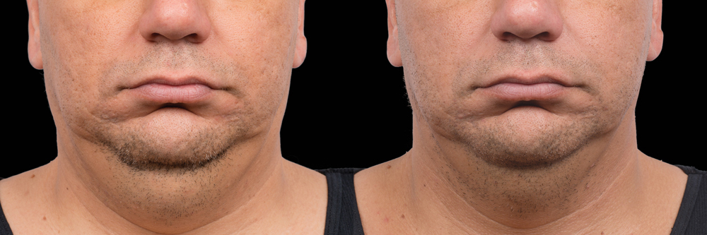CoolSculpting before and after photo by Columbus Institute of Plastic Surgery in Columbus, OH