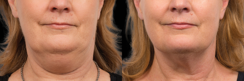 CoolSculpting before and after photo by Columbus Institute of Plastic Surgery in Columbus, OH