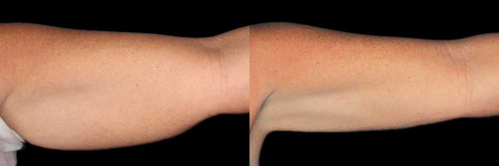 CoolSculpting before and after photo by Columbus Institute of Plastic Surgery in Columbus, OH
