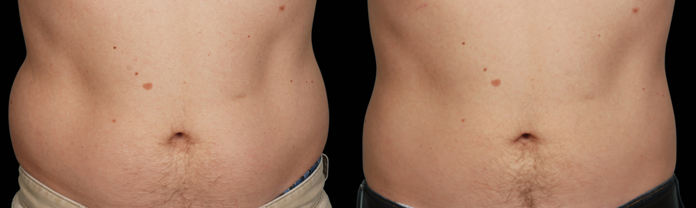 CoolSculpting before and after photo by Columbus Institute of Plastic Surgery in Columbus, OH
