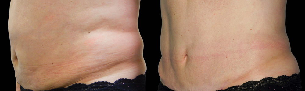 CoolSculpting before and after photo by Columbus Institute of Plastic Surgery in Columbus, OH