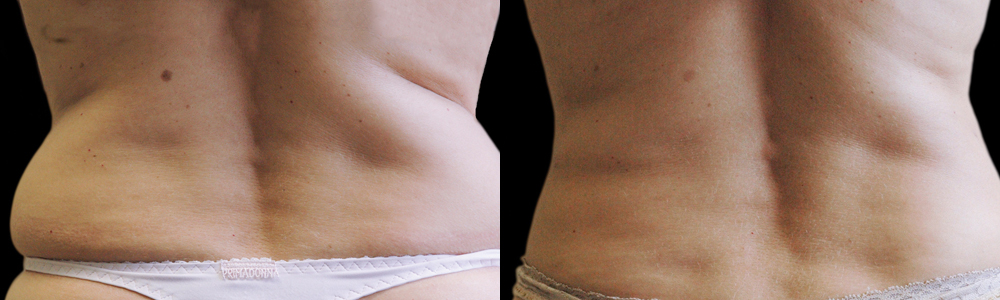 CoolSculpting before and after photo by Columbus Institute of Plastic Surgery in Columbus, OH