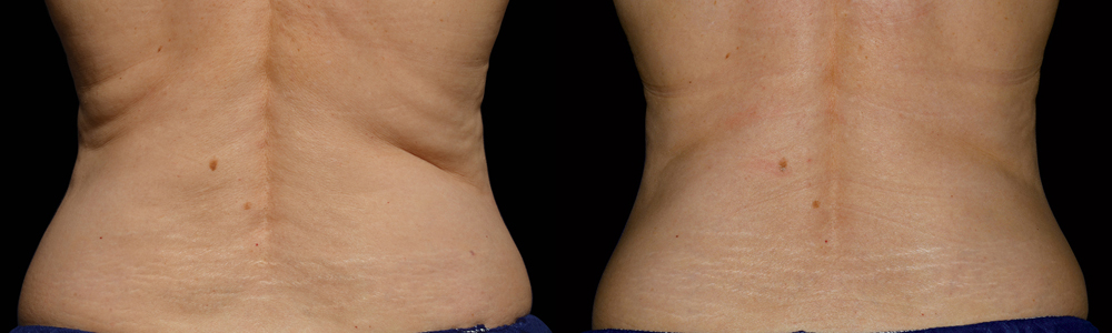 CoolSculpting before and after photo by Columbus Institute of Plastic Surgery in Columbus, OH