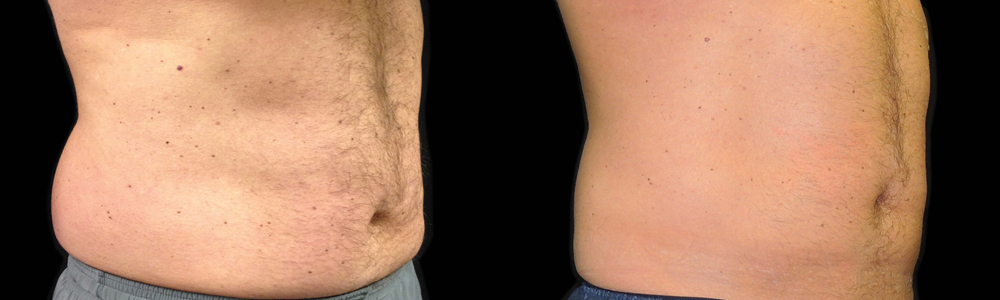 CoolSculpting before and after photo by Columbus Institute of Plastic Surgery in Columbus, OH