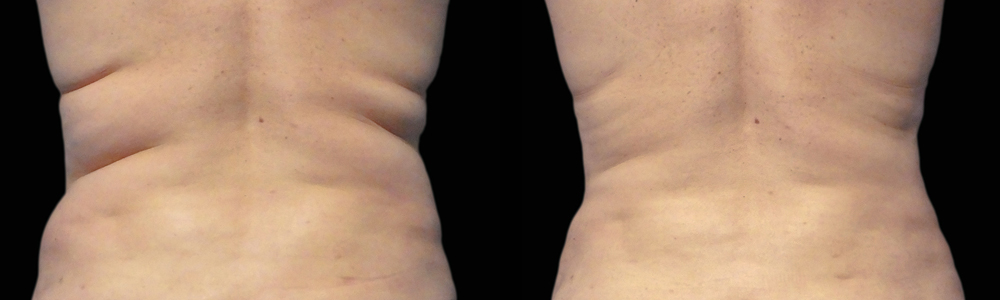 CoolSculpting before and after photo by Columbus Institute of Plastic Surgery in Columbus, OH