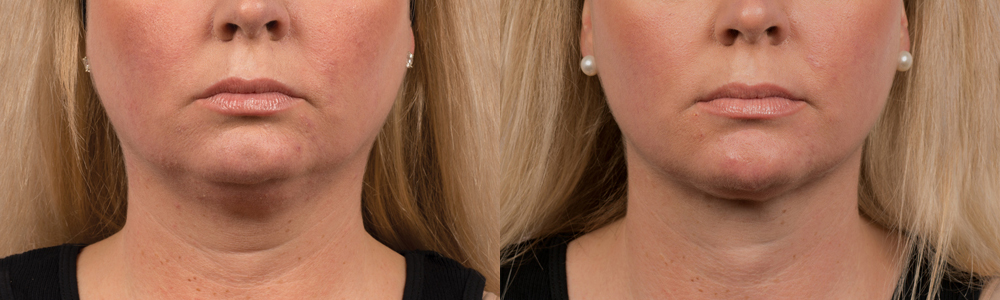 CoolSculpting before and after photo by Columbus Institute of Plastic Surgery in Columbus, OH