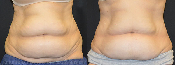CoolSculpting before and after photo by Columbus Institute of Plastic Surgery in Columbus, OH