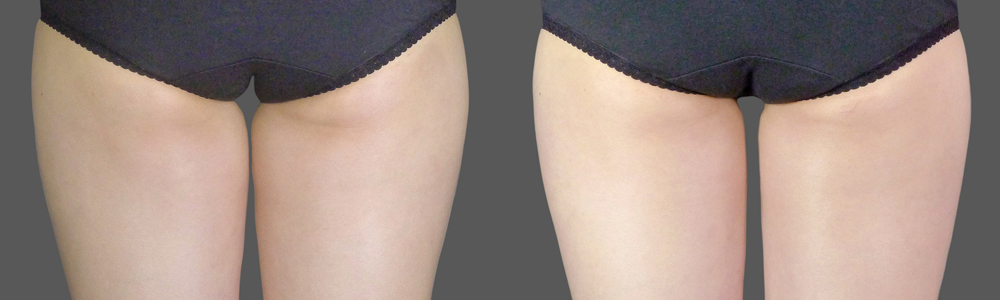 CoolSculpting before and after photo by Columbus Institute of Plastic Surgery in Columbus, OH