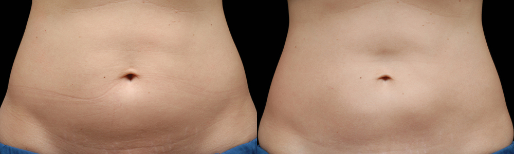 CoolSculpting before and after photo by Columbus Institute of Plastic Surgery in Columbus, OH