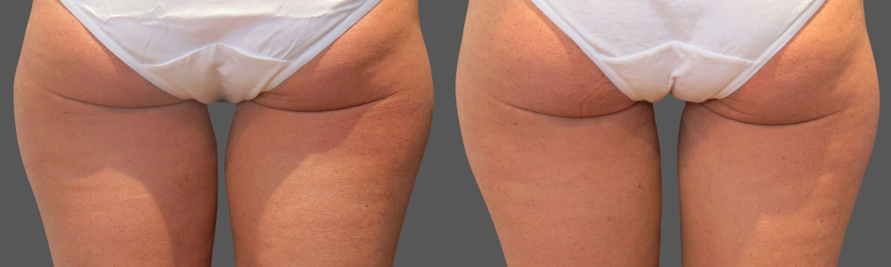 CoolSculpting before and after photo by Columbus Institute of Plastic Surgery in Columbus, OH