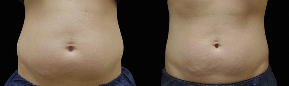 CoolSculpting before and after photo by Columbus Institute of Plastic Surgery in Columbus, OH