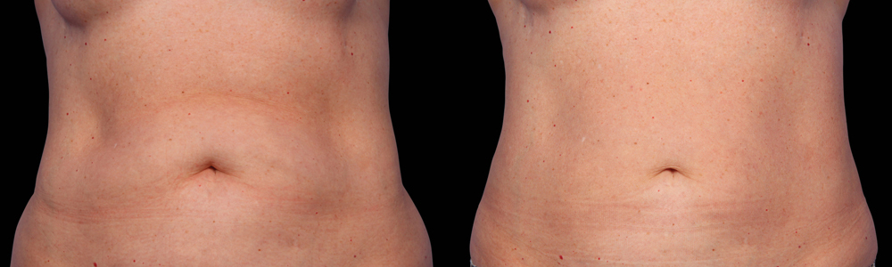 CoolSculpting before and after photo by Columbus Institute of Plastic Surgery in Columbus, OH