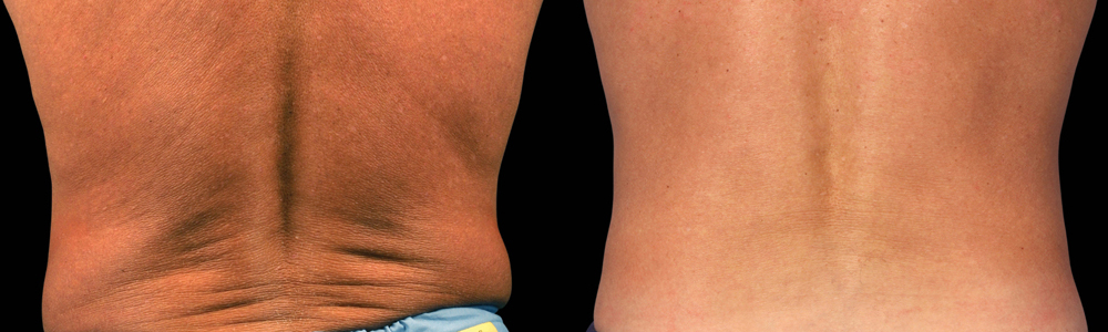 CoolSculpting before and after photo by Columbus Institute of Plastic Surgery in Columbus, OH