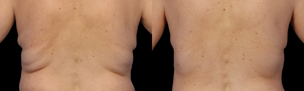CoolSculpting before and after photo by Columbus Institute of Plastic Surgery in Columbus, OH