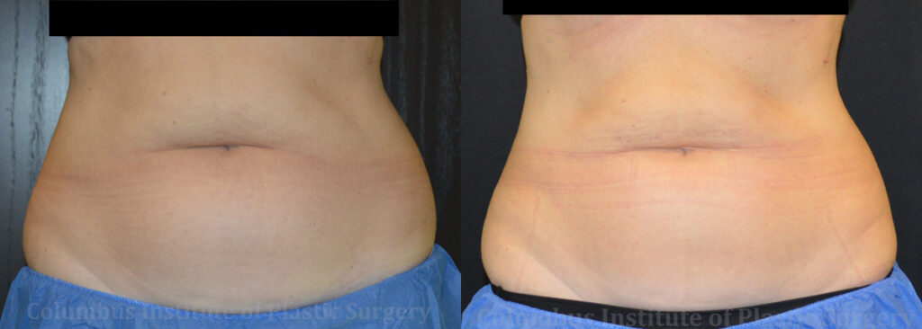 CoolSculpting before and after photo by Columbus Institute of Plastic Surgery in Columbus, OH