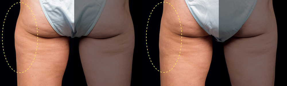 CoolSculpting before and after photo by Columbus Institute of Plastic Surgery in Columbus, OH