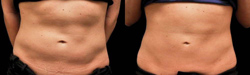 CoolSculpting before and after photo by Columbus Institute of Plastic Surgery in Columbus, OH