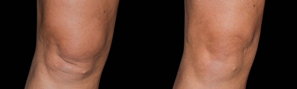 CoolSculpting before and after photo by Columbus Institute of Plastic Surgery in Columbus, OH