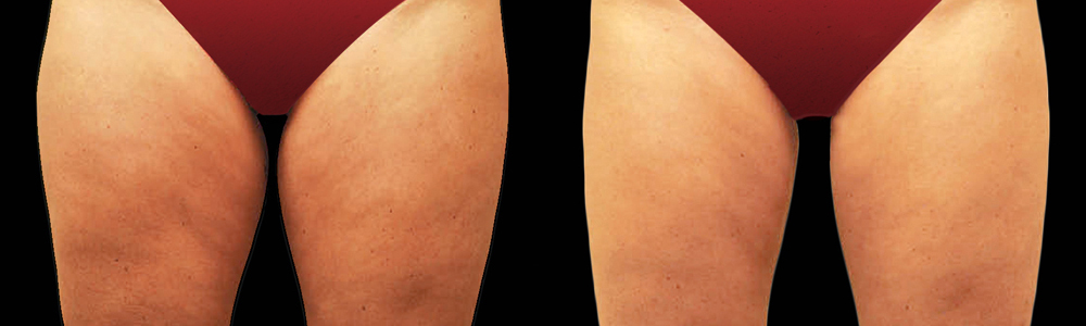 CoolSculpting before and after photo by Columbus Institute of Plastic Surgery in Columbus, OH