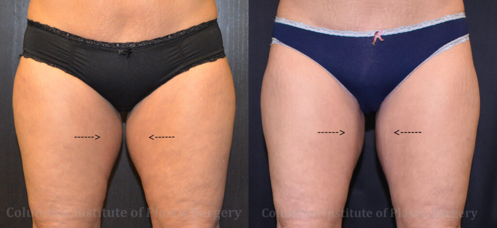 CoolSculpting before and after photo by Columbus Institute of Plastic Surgery in Columbus, OH